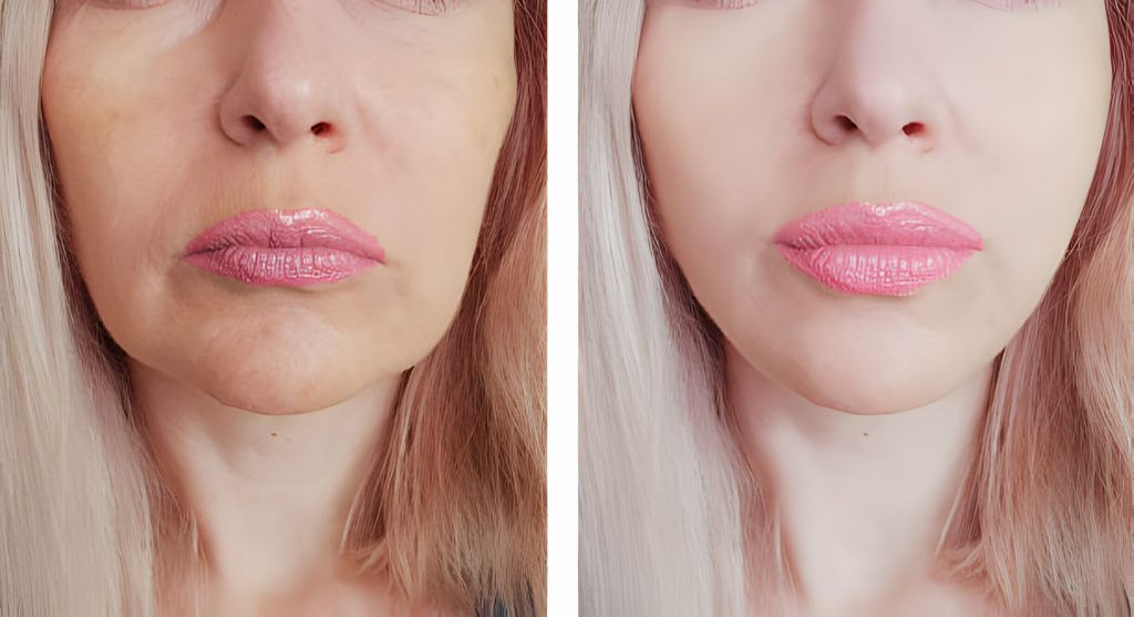masseter botox before and after